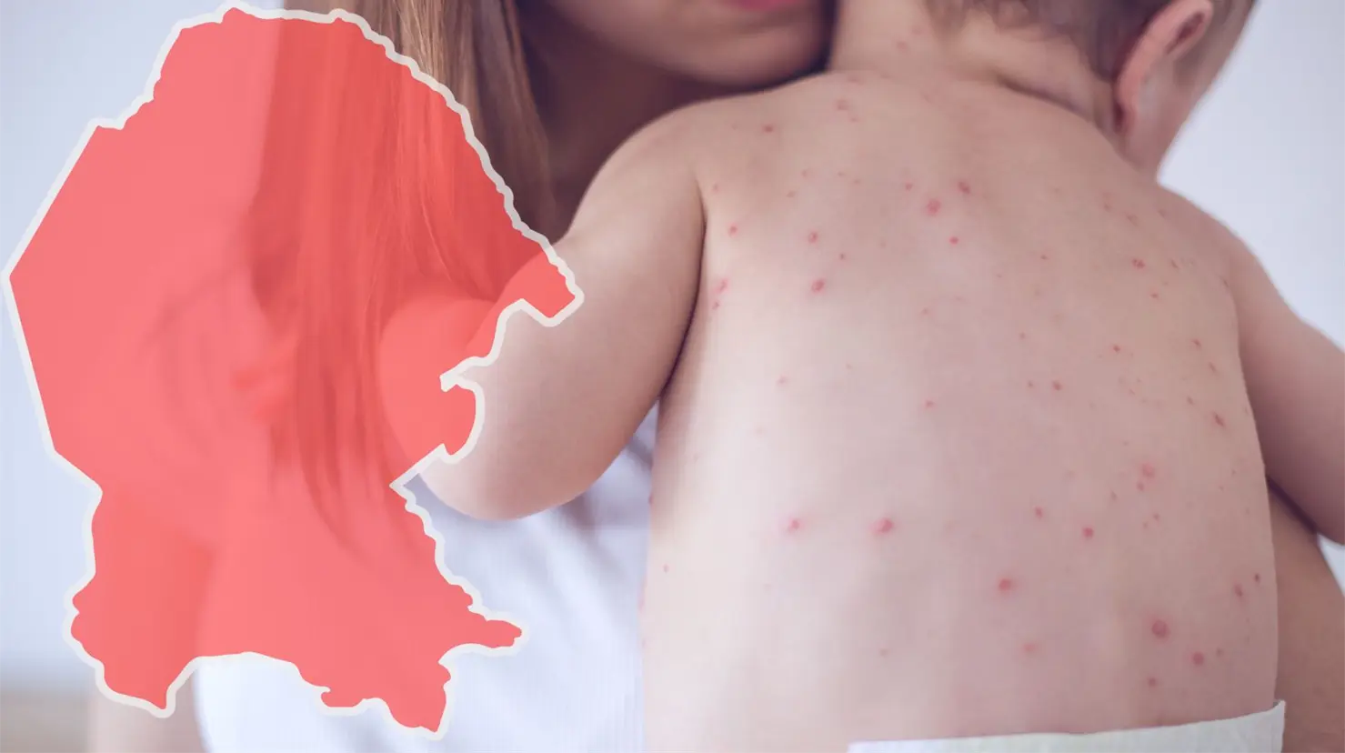 Coahuila suma 55 casos de sarampión. (Fotografía: Canva)