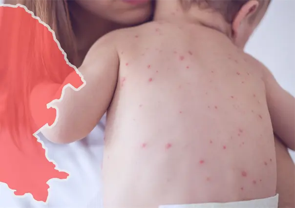 Coahuila registra tercer lugar nacional por casos de sarampión en 2025