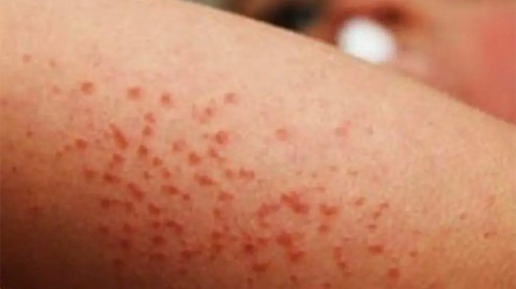 Más de 100 casos de Coxsackie en Tamaulipas, Secretaría de Salud pide reforzar medidas preventivas
