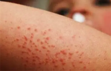 Más de 100 casos de Coxsackie en Tamaulipas, Secretaría de Salud pide reforzar medidas preventivas