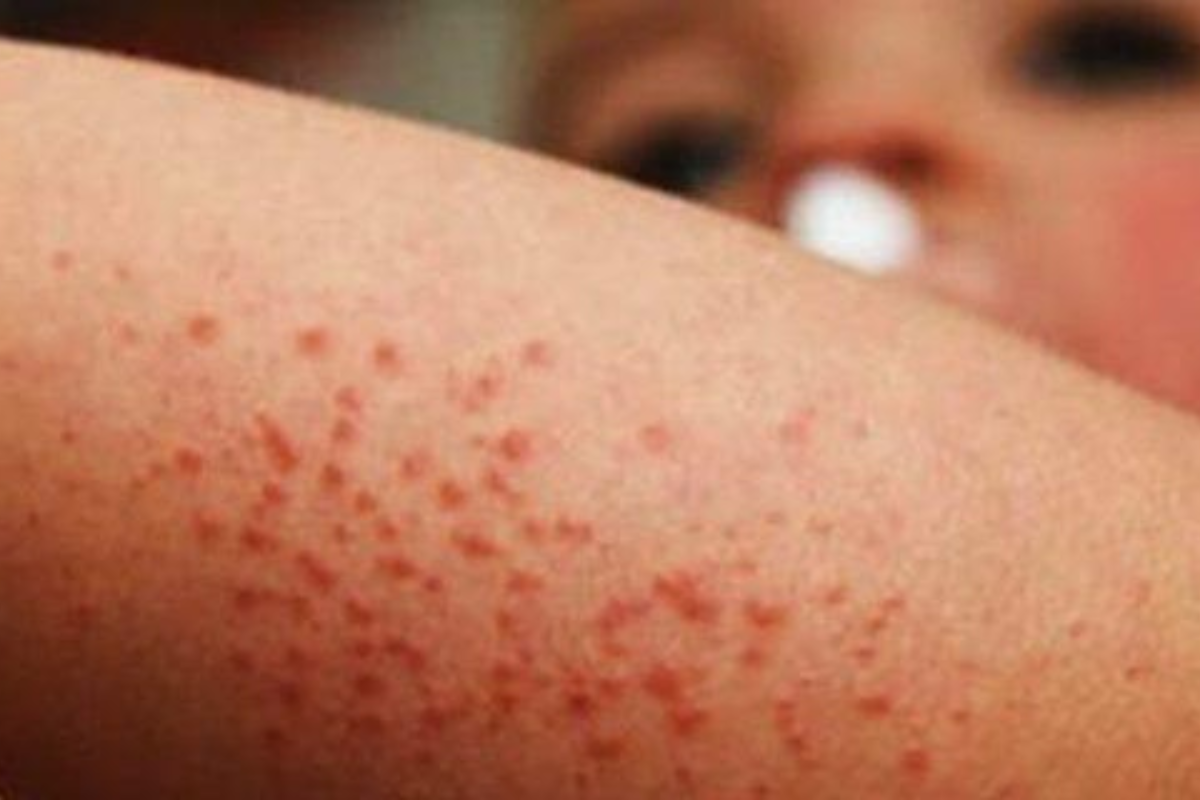 Más de 100 casos de Coxsackie en Tamaulipas, Secretaría de Salud pide reforzar medidas preventivas