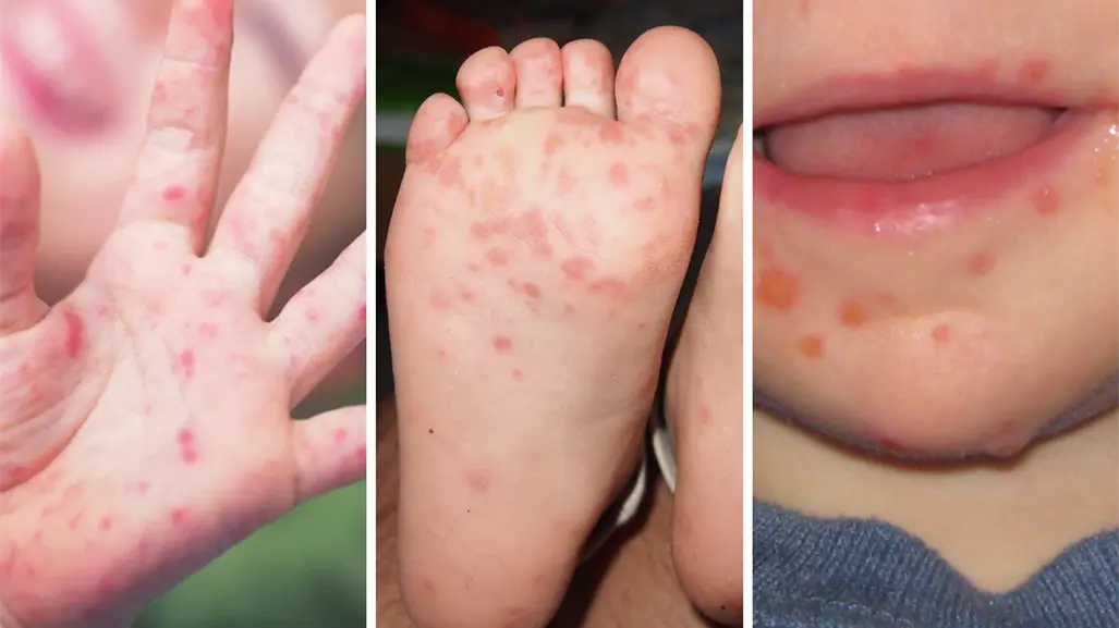 3 medidas para prevenir y frenar un brote de Coxsackie, de acuerdo con Salud Tamaulipas