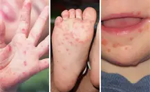 3 medidas para prevenir y frenar un brote de Coxsackie, de acuerdo con Salud Tamaulipas
