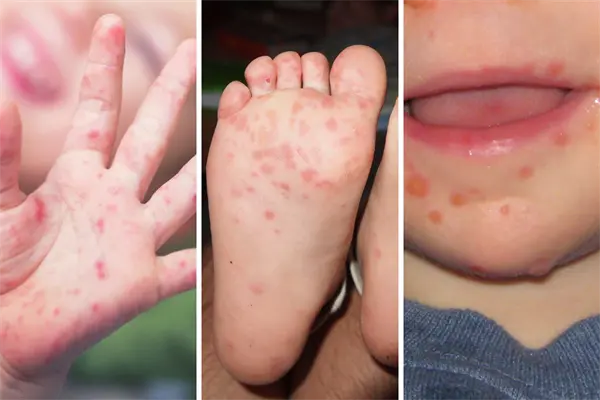 3 medidas para prevenir y frenar un brote de Coxsackie, de acuerdo con Salud Tamaulipas
