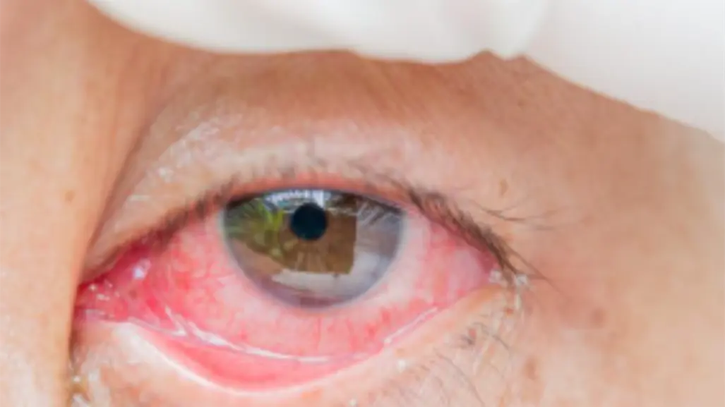 Lluvias e inundaciones provocan brote de conjuntivitis en Tamaulipas