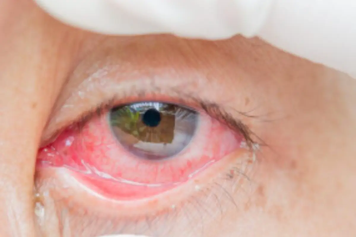 Tamaulipas el cuarto estado con más contagios de conjuntivitis | Foto: Perla Herrera