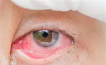 Lluvias e inundaciones provocan brote de conjuntivitis en Tamaulipas