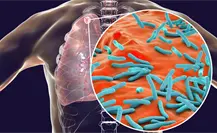 Tuberculosis en Edomex preocupa por falta de vacuna BCG y especialistas piden medidas preventivas Tuberculosis en Edomex preocupa por falta de vacuna BCG y especialistas piden medidas preventivas