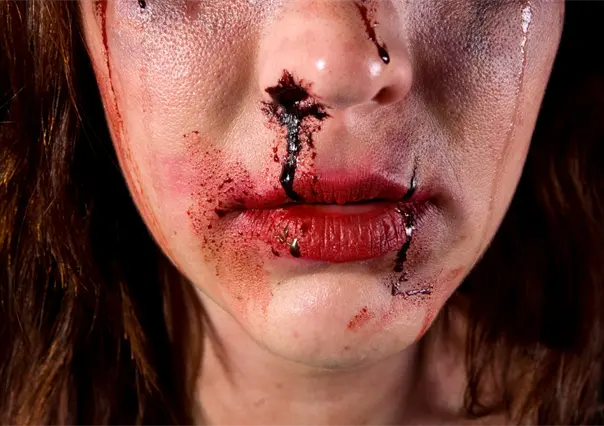 Mujer es golpeada por amigas tras presuntamente hablar con el exnovio de una y casi pierde un ojo