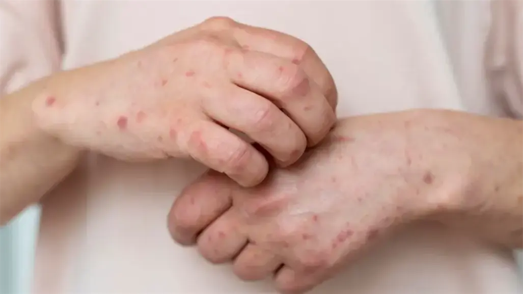 Tamaulipas en vigilancia epidemiológica: 12 casos de sarampión confirmados