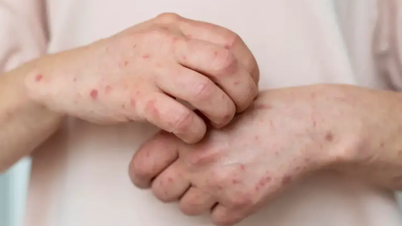 Con 12 casos confirmados, Tamaulipas está en vigilancia epidemiológica por sarampión; conoce los síntomas y cómo actuar ante ellos.