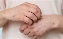 Tamaulipas en vigilancia epidemiológica: 12 casos de sarampión confirmados Tamaulipas en vigilancia epidemiológica: 12 casos de sarampión confirmados