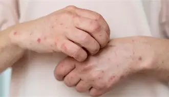 Tamaulipas en vigilancia epidemiológica: 12 casos de sarampión confirmados