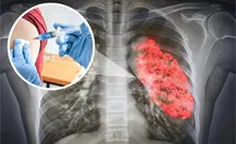 Coahuila registra alza en casos de neumonía, este es el plan preventivo previo al invierno Coahuila registra alza en casos de neumonía, este es el plan preventivo previo al invierno