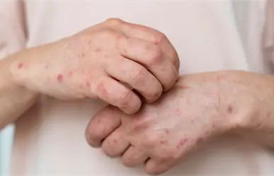 Salud: en Tamaulipas no se han suspendido clases por brote de Coxsackie