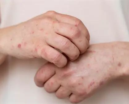 Salud: en Tamaulipas no se han suspendido clases por brote de Coxsackie