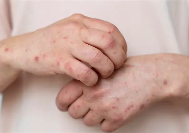 Salud: en Tamaulipas no se han suspendido clases por brote de Coxsackie