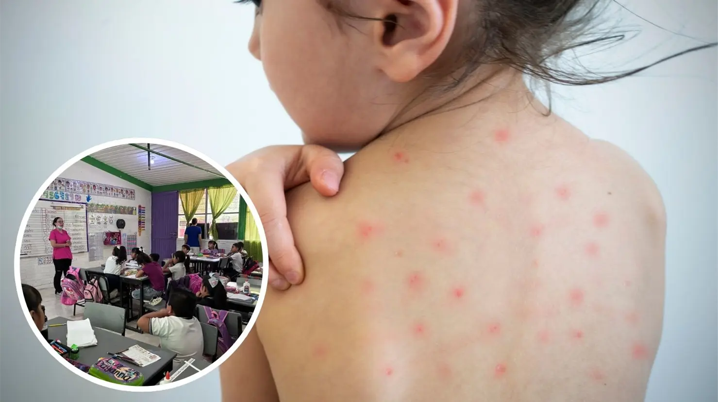 Niña con varicela. Imagen de la primaria Gustavo Díaz Ordaz en Piedras Negras. (Fotografías: Canva |Facebook: Primaria Gustavo Díaz Ordaz)