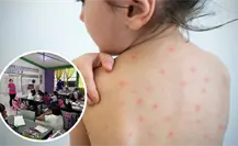 Varicela en Piedras Negras: Reportan brote en primaria; hay 9 niños contagiados Varicela en Piedras Negras: Reportan brote en primaria; hay 9 niños contagiados
