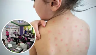 Varicela en Piedras Negras: Reportan brote en primaria; hay 9 niños contagiados