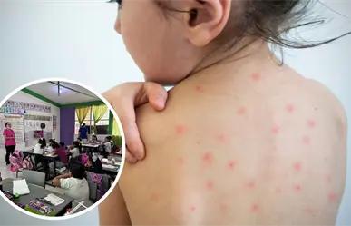 Varicela en Piedras Negras: Reportan brote en primaria; hay 9 niños contagiados