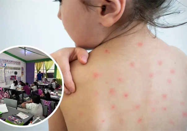 Varicela en Piedras Negras: Reportan brote en primaria; hay 9 niños contagiados