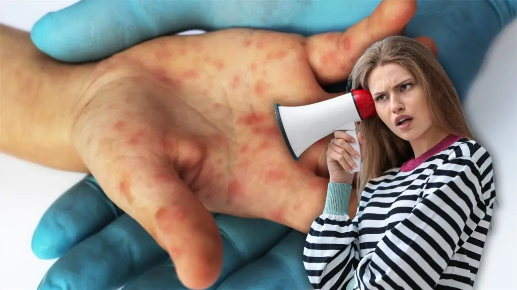 ¡Atención mamás y papás! este virus se propaga rápido y pone en riesgo a los más pequeños