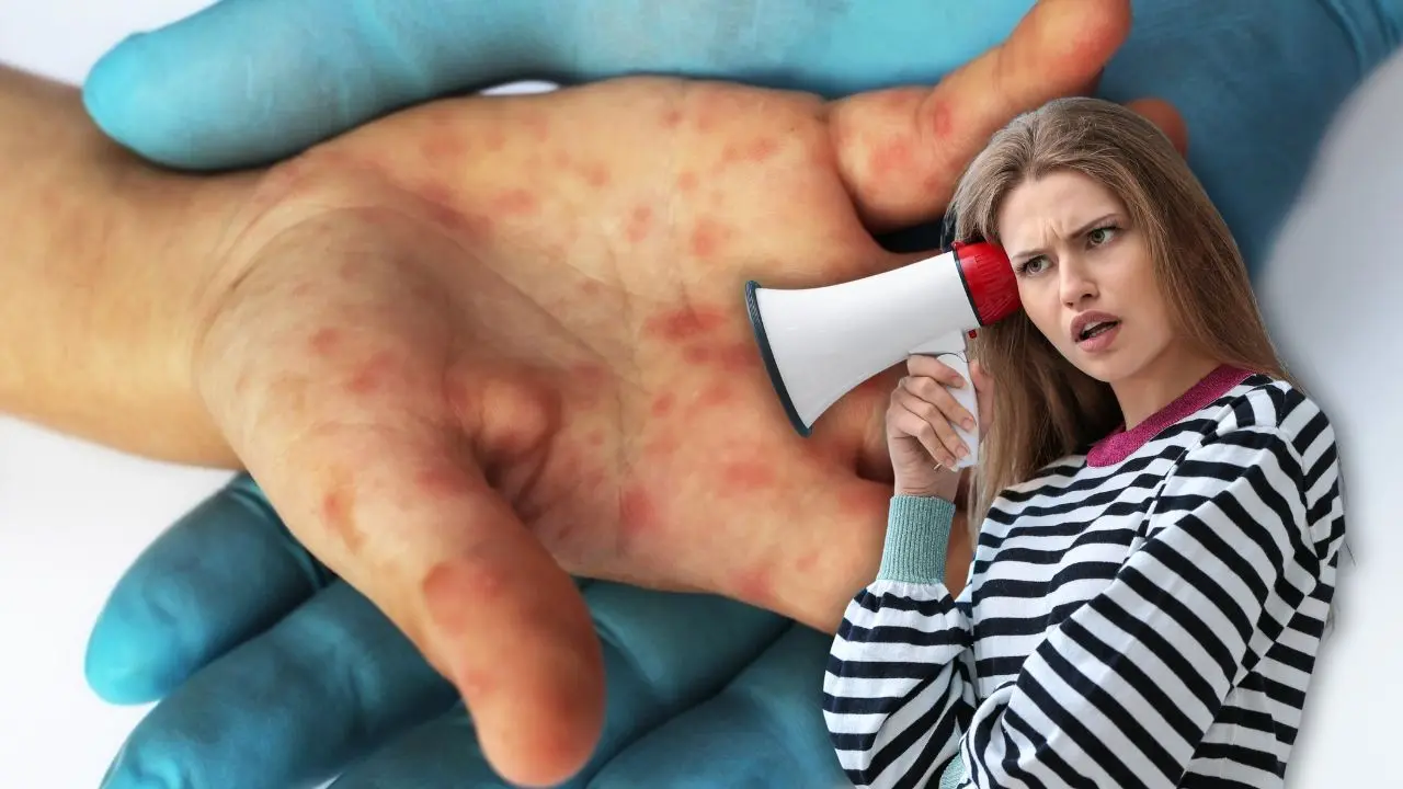 Detalle de la mano de un niño afectado por la enfermedad manos, pies y boca Foto: Canva