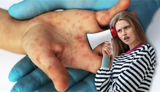 ¡Atención mamás y papás! este virus se propaga rápido y pone en riesgo a los más pequeños