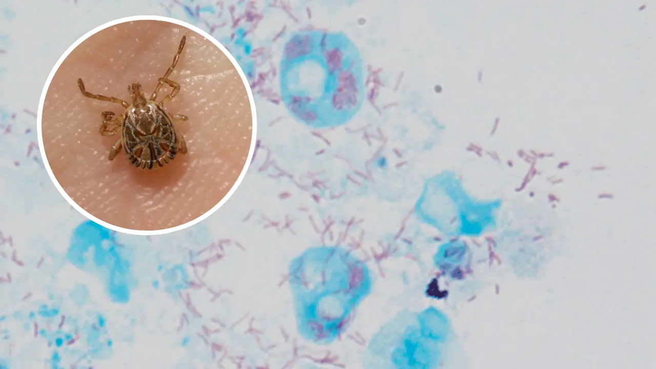 El diagnóstico temprano es clave para salvar vidas pues, durante las primeras 72 horas los pacientes deben recibir tratamiento inmediato./Foto: Canva/ Vircell