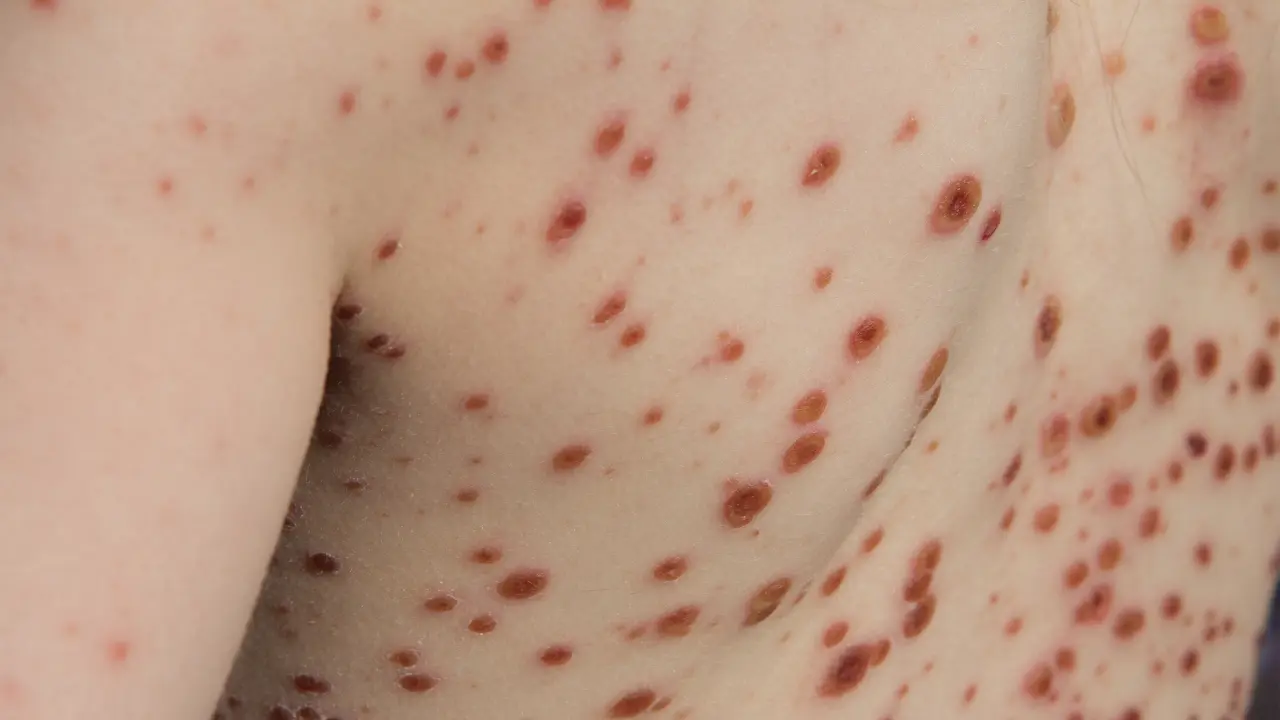 La varicela es una enfermedad prevenible por vacuna. Foto: Canva