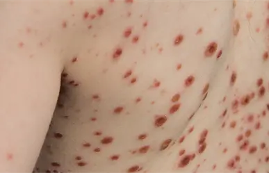 Edomex reporta alza de varicela en noviembre y revela los municipios que registran más contagios