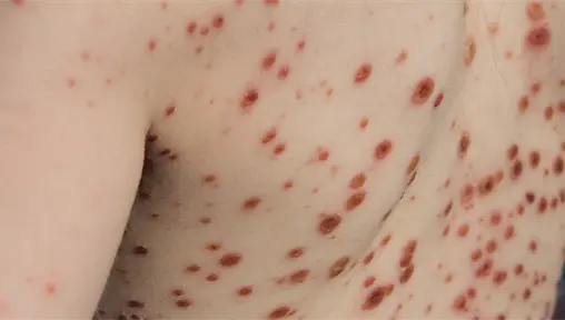 Edomex reporta alza de varicela en noviembre y revela los municipios que registran más contagios