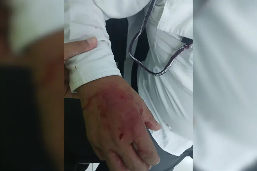 Lesiones sufridas por parte del agente de tránsito durante el enfrentamiento. Foto: Axel Hassel