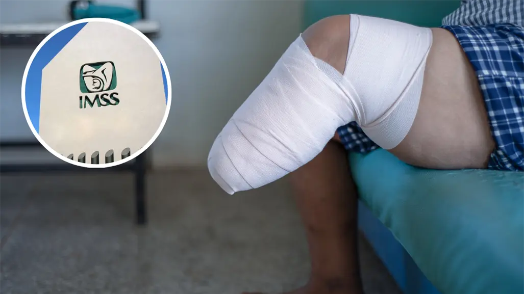 IMSS Coahuila realiza casi mil amputaciones al año, esta es la causa