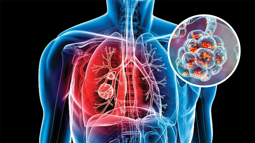 Coahuila registra más de 700 casos de tuberculosis al año, ¿qué es esta enfermedad?