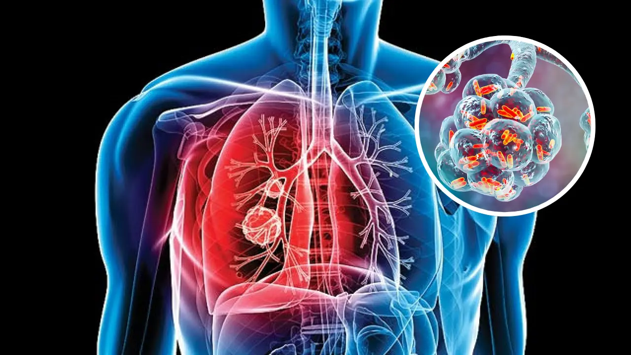 Su transmisión ocurre a través del aire cuando una persona enferma tose, estornuda, habla o canta, liberando pequeñas gotas que otros pueden respirar. /Foto: Un ensayo para mí | Clínica Ciudad del Mar