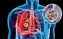 Coahuila registra más de 700 casos de tuberculosis al año, ¿qué es esta enfermedad? Coahuila registra más de 700 casos de tuberculosis al año, ¿qué es esta enfermedad?