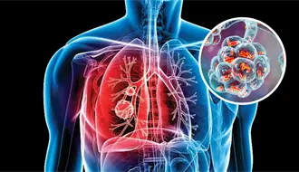 Coahuila registra más de 700 casos de tuberculosis al año, ¿qué es esta enfermedad?