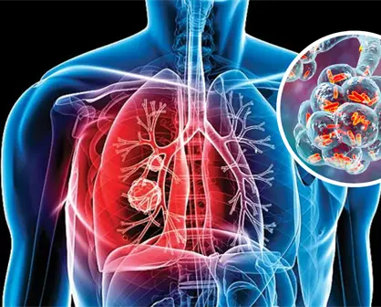 Coahuila registra más de 700 casos de tuberculosis al año, ¿qué es esta enfermedad?