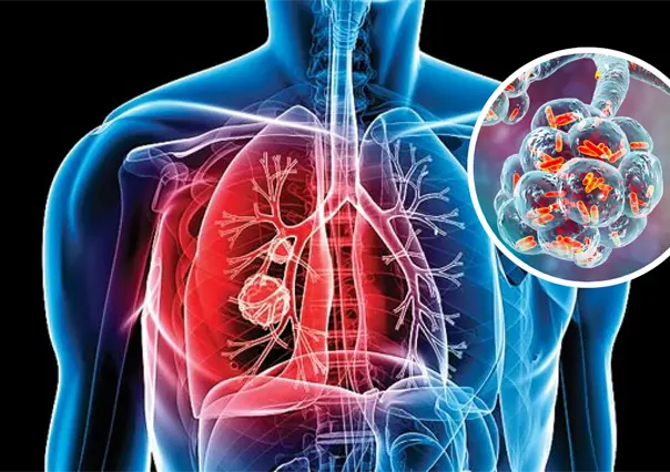 Coahuila registra más de 700 casos de tuberculosis al año, ¿qué es esta enfermedad?