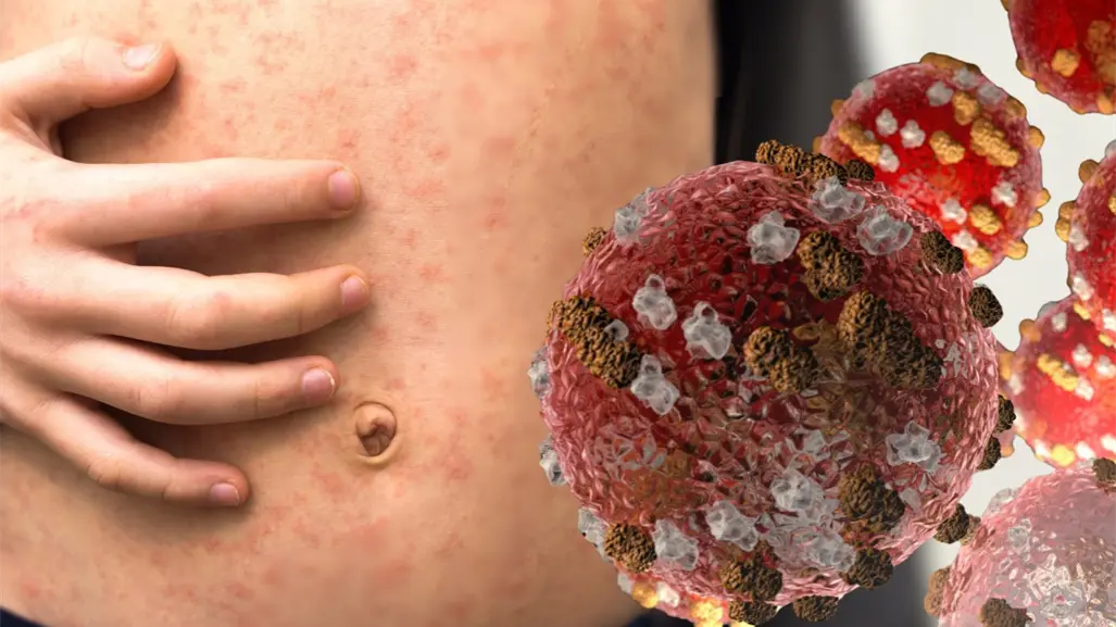 CDMX confirma 5 nuevos casos de sarampión; refuerza vacunación en estas alcaldías