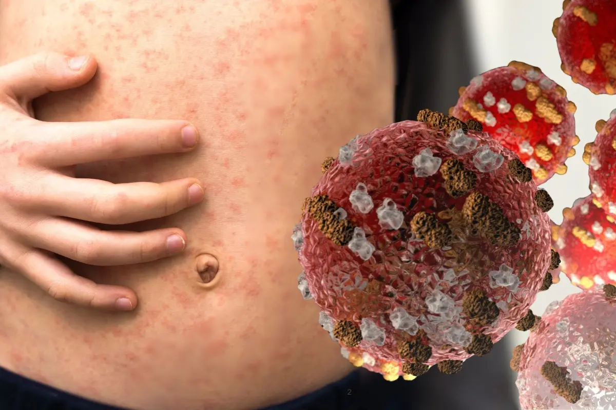 Sarampión regresa a la CDMX; cinco contagios confirmados y nuevas medidas en estas 2 alcaldías. Foto: Canva