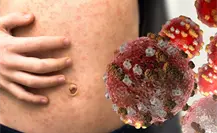 CDMX confirma 5 nuevos casos de sarampión; refuerza vacunación en estas alcaldías CDMX confirma 5 nuevos casos de sarampión; refuerza vacunación en estas alcaldías