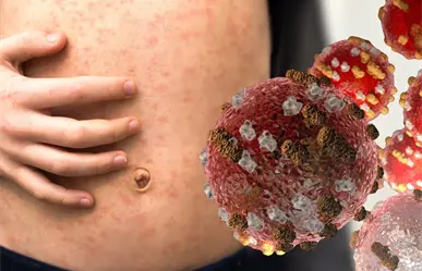 CDMX confirma 5 nuevos casos de sarampión; refuerza vacunación en estas alcaldías