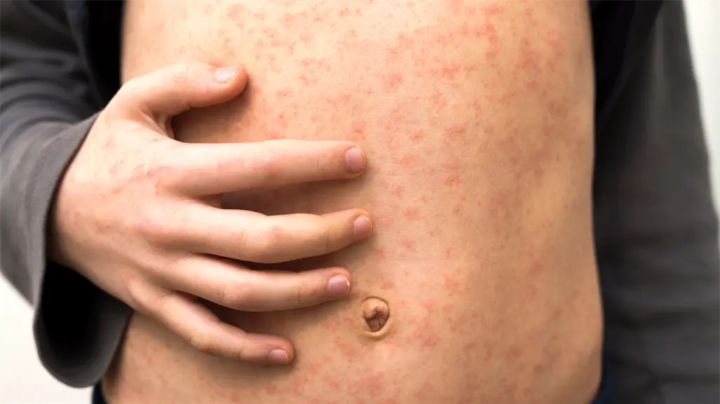 Querétaro analiza mega jornada de vacunación contra el sarampión tras nuevos casos importados