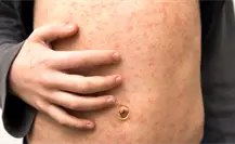 Querétaro analiza mega jornada de vacunación contra el sarampión tras nuevos casos importados Querétaro analiza mega jornada de vacunación contra el sarampión tras nuevos casos importados