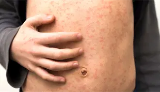 Querétaro analiza mega jornada de vacunación contra el sarampión tras nuevos casos importados