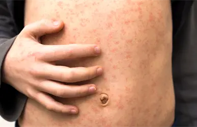 Querétaro analiza mega jornada de vacunación contra el sarampión tras nuevos casos importados