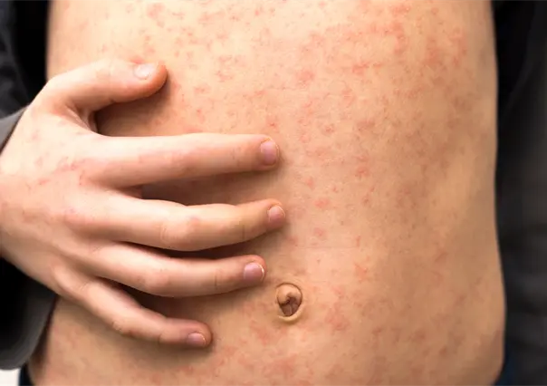 Querétaro analiza mega jornada de vacunación contra el sarampión tras nuevos casos importados